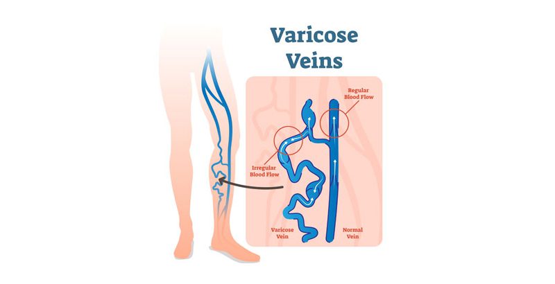 carolina-cardiology-associates-varicose-vein-chart